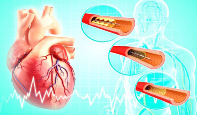 Going for Angioplasty? This is How you Should Prepare
